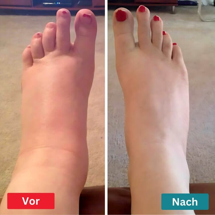 1+1 GRATIS | FeetRelief™ Die ultimative Neuropathie Fuß Relief