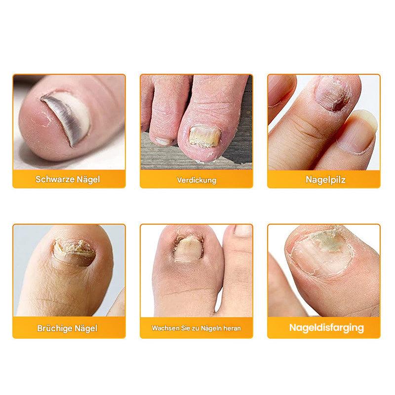 1+1 Gratis | Nailox™ Pflanzliche Formel, die tief eindringt, um Nägel zu heilen und zu erneuern