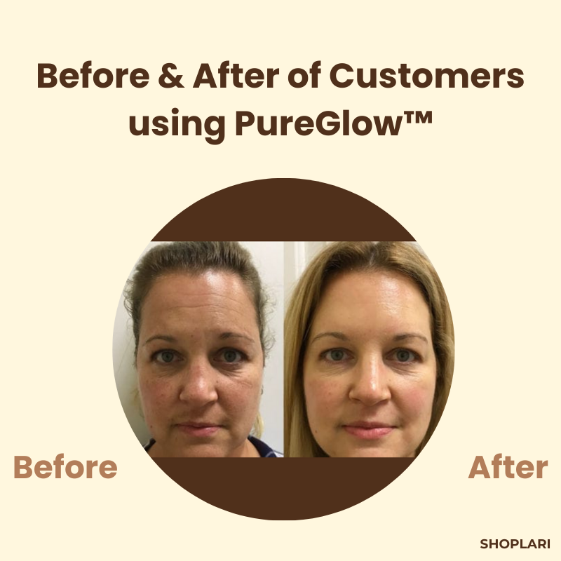1+1 GRATIS | PureGlow™ Schwarze Tee Maske — Flecken entfernen und strahlendes Selbstvertrauen zeigen