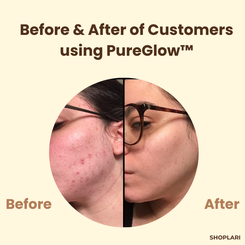 1+1 GRATIS | PureGlow™ Schwarze Tee Maske — Flecken entfernen und strahlendes Selbstvertrauen zeigen