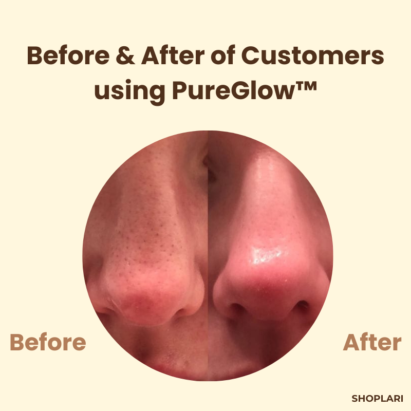1+1 GRATIS | PureGlow™ Schwarze Tee Maske — Flecken entfernen und strahlendes Selbstvertrauen zeigen